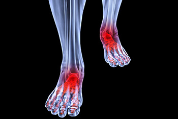 Arthritic foot and ankle care treatment in the Collin County TX, Plano, Frisco, Allen, Murphy, Lucas, Dallas County TX, Garland, Carrollton, Richardson, Farmers Branch, Sachse, Addison areas